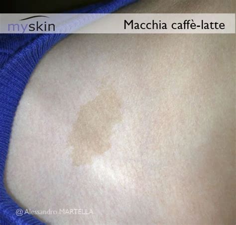 rappresentazione illustrativa di una macchia caffè-latte sulla pelle infantile
