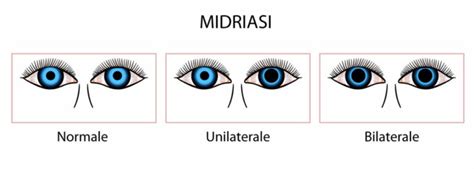 Tipi di midriasi: reagente, fissa, unilaterale, bilaterale