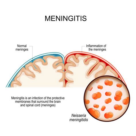 rappresentazione microscopica di Neisseria meningitidis