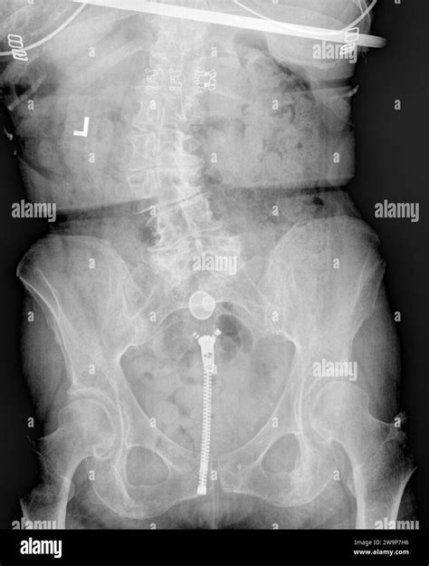 Immagine radiografica di un'isterosalpingografia che mostra tube pervie