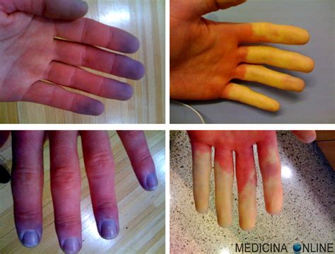 Ciclo di Raynaud (Pallore, Cianosi, Rossore)
