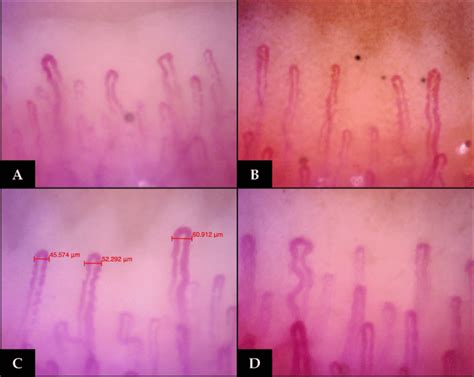 Videocapillaroscopia periungueale