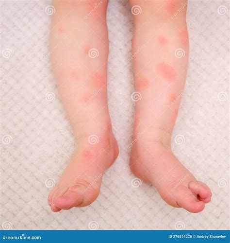 Effetti delle salviette sulla pelle del bambino