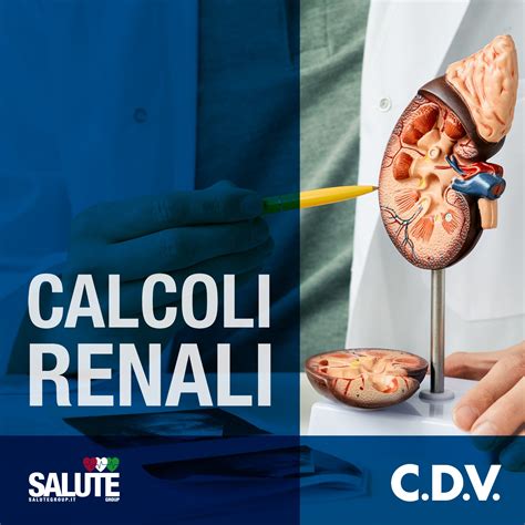 Infografica sulla tecnica PDI per l'espulsione dei calcoli