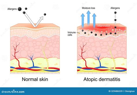 illustrazione scientifica della struttura cutanea e infiammazione atopica