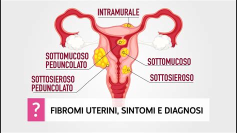 Illustrazione delle diverse cause di sanguinamento vaginale (polipi, fibromi, infezioni)
