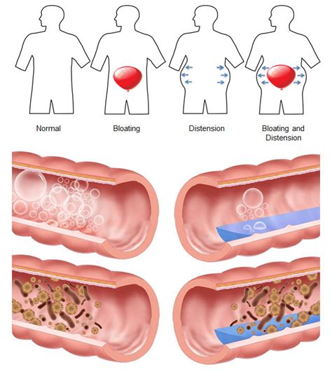 infografica che mostra la differenza tra gonfiore da gas e infiammazione intestinale