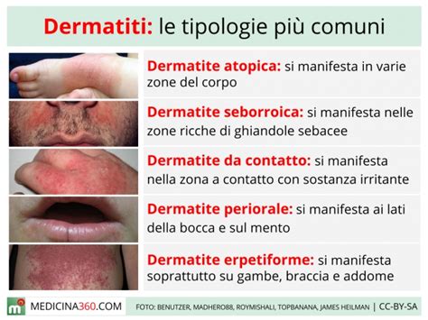 Tipi di Dermatite da Contatto