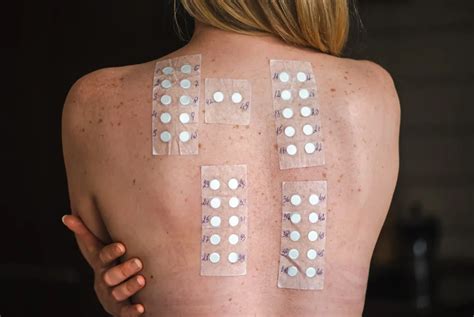 Esempio di Patch Test