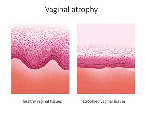 Vaginal atrophy diagram menopause
