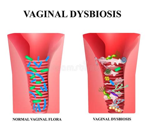 Flora vaginale sana vs disbiosi