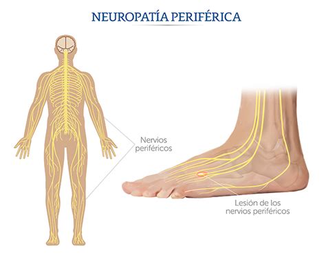 Illustrazione delle fibre nervose in un paziente con neuropatia periferica ereditaria