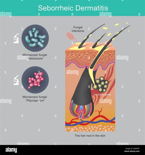 Illustrazione della dermatite seborroica sul cuoio capelluto e sul viso