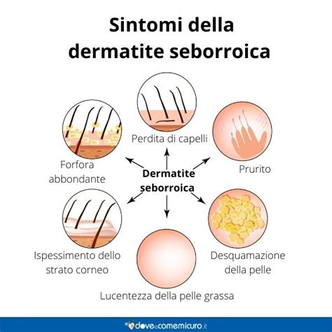 Infografica sui consigli per la gestione della dermatite seborroica