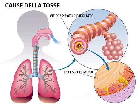 schema del riflesso della tosse e interferenza gastrica