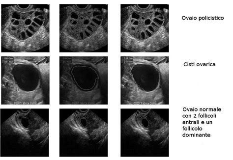 Ecografia transvaginale che mostra le ovaie con i follicoli