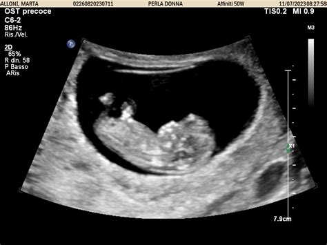 Ecografia fetale durante il primo trimestre