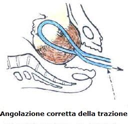 Illustrazione del forcipe e della ventosa ostetrica