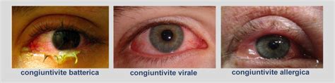 Congiuntivite nell'artrite reattiva da clamidia