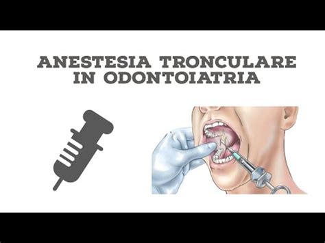 Schema dell'anestesia locale in ambito odontoiatrico