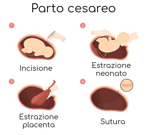 Tassi di parto cesareo in diversi paesi
