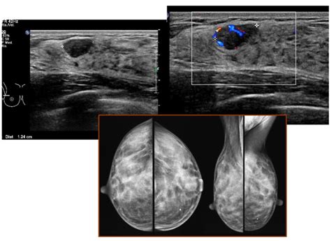 Donna incinta o che allatta sottoposta a ecografia mammaria per controllo