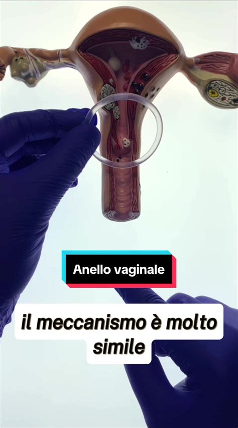 Schema di inserimento di un ovulo vaginale
