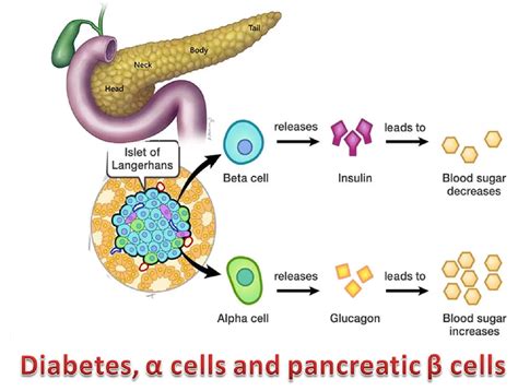 diagramma che illustra la distruzione delle cellule beta del pancreas nel diabete di tipo 1