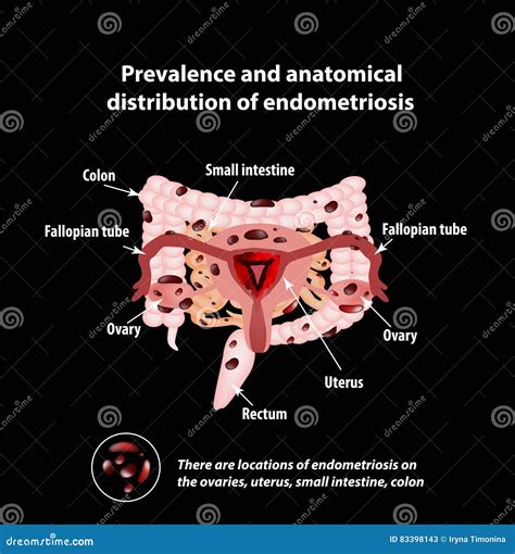 Schema dell'endometriosi