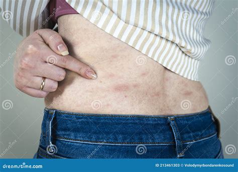 Eruzione cutanea pruriginosa tipica della gravidanza (PUPPP)