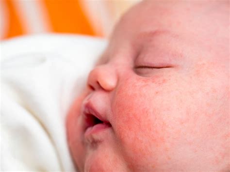 primo piano del viso di un neonato con lievi puntini rossi sulle guance