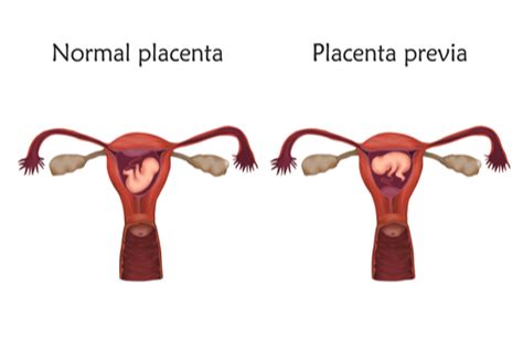 Placenta previa vs Normal placenta