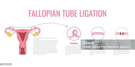 diagramma delle tube di Falloppio e ostacoli anatomici