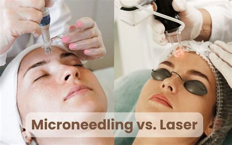 diagramma comparativo dei trattamenti laser vs micro-needling
