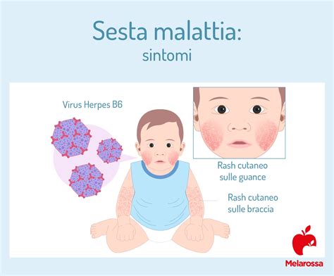 Esantema della Sesta Malattia