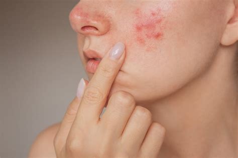 Megaloritema infettivo sulle guance