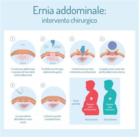 Rappresentazione di un'ecografia addominale per la diagnosi di ernia