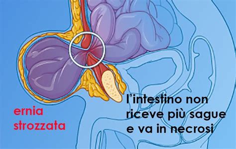 Diagramma che illustra ernia incarcerata e strozzata