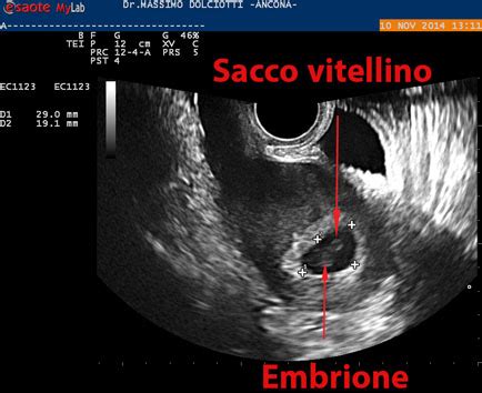 Ecografia che mostra un aborto interno (embrione senza battito)