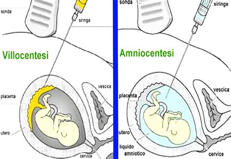 Schema illustrativo della procedura di amniocentesi con indicazione dell'ago sottile guidato da ecografia