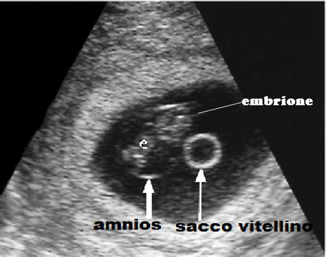 Sacco gestazionale con embrione e sacco vitellino