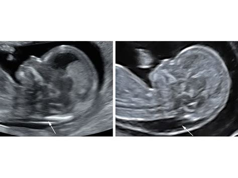 Diagramma Translucenza Nucale