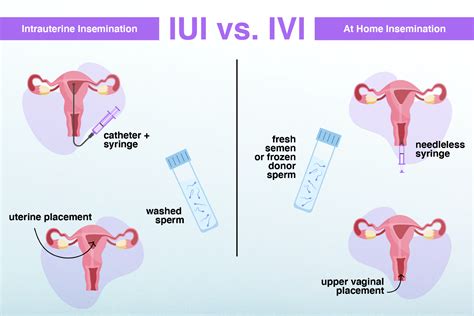 Diagramma procedura IUI