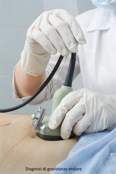 Innovazione nell'ago per amniocentesi sviluppato dal Prof. Giorlandino