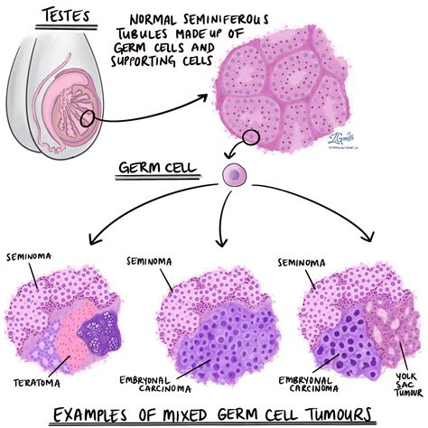 Diagrama ilustrando tumores de células germinativas