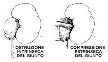 Stenosi del giunto pieloureterale e sue conseguenze