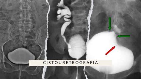 Cistouretrografia minzionale: tecnica e risultati