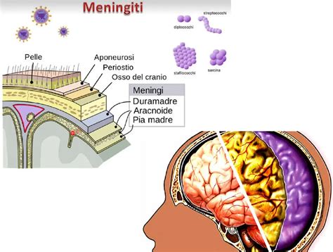 diagramma che illustra la riduzione dell'incidenza di meningite batterica in relazione all'introduzione dei vaccini