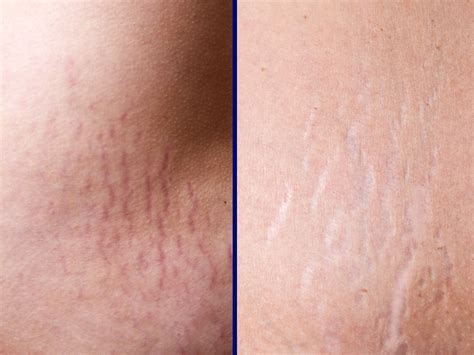 Struttura della pelle con smagliature e cicatrici