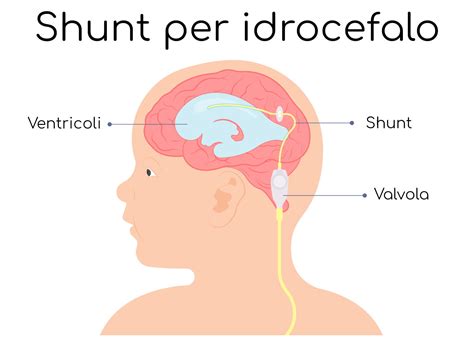 Schema di uno shunt vescico-amniotico